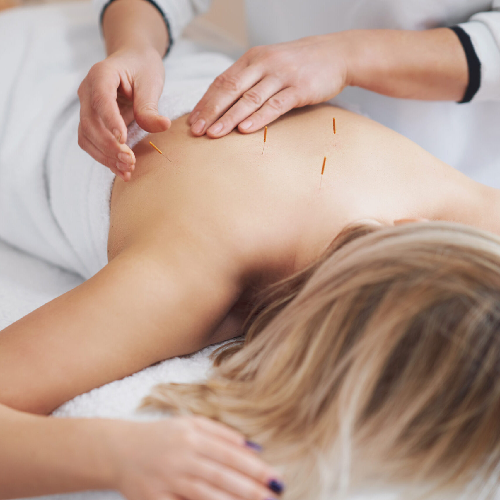 Featured Photo for “What Is The Difference Between Dry Needling and Acupuncture?” Blog Article A woman resting on the massage table during an acupuncture or dry needling treatment. Although they may look similar, there are differences between dry needling and acupuncture.