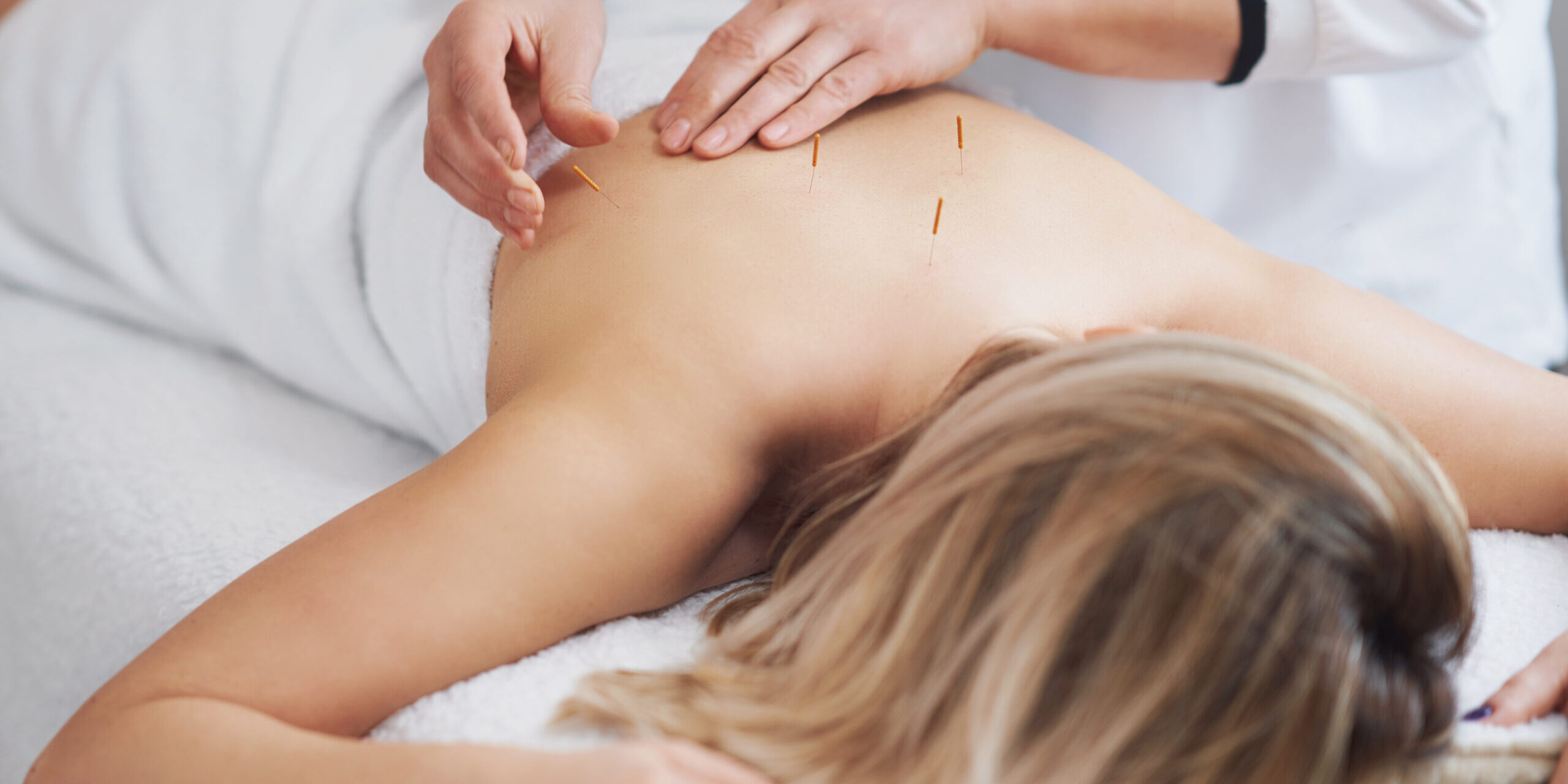 A woman resting on the massage table during an acupuncture or dry needling treatment. Although they may look similar, there are differences between dry needling and acupuncture.