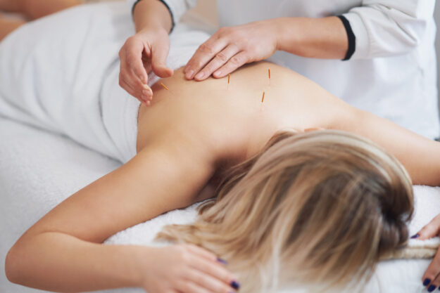 A woman resting on the massage table during an acupuncture or dry needling treatment. Although they may look similar, there are differences between dry needling and acupuncture.